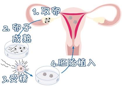 试管代孕包成功男孩